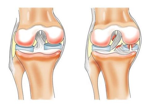 rodilla sana y osteoartritis de la articulación de la rodilla