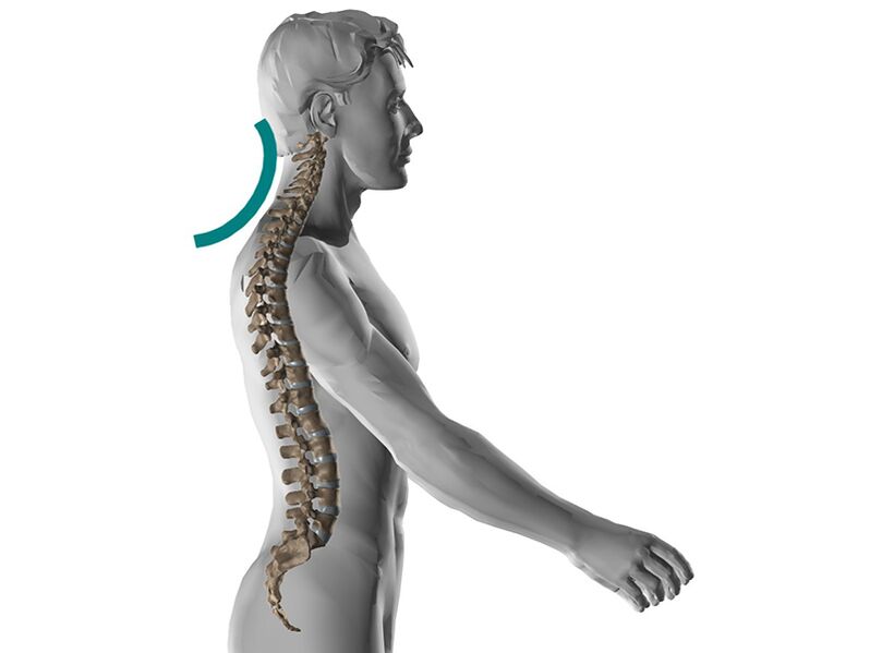 Osteocondrosis cervical de la columna vertebral, que causa muchos síntomas desagradables. 