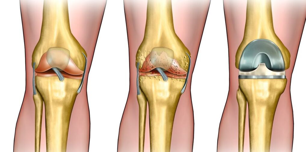 Artrosis de la articulación de la rodilla